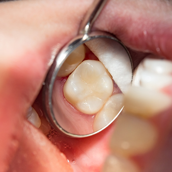 Brittney K. Craig, DMD | Gum Therapy, Bonding and Dentures